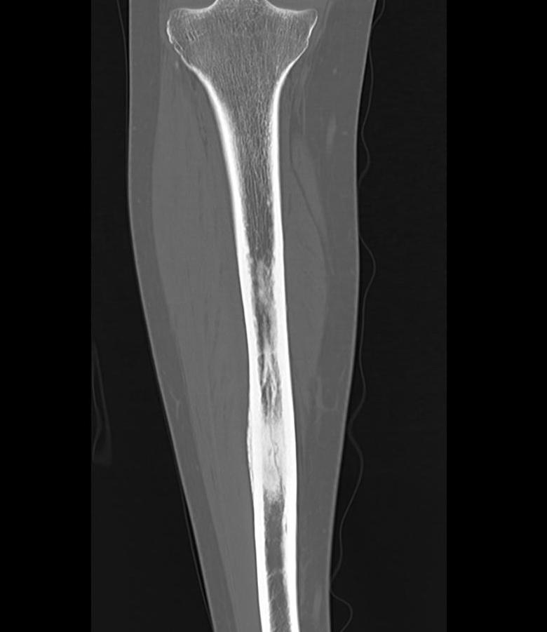 Tibial Lesion Sclerotic